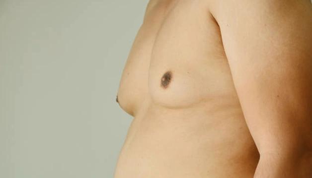 What is Gynecomastia?