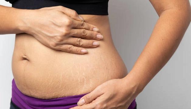 About Stretch Marks Removal