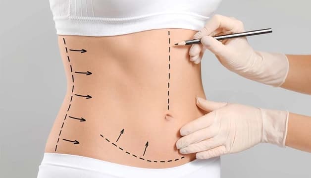 About Tummy Tuck Procedure