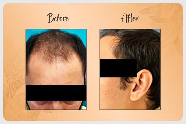 Before and After Hair Transplant 1