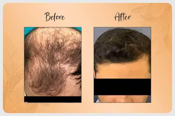 Before and After Hair Transplant 2