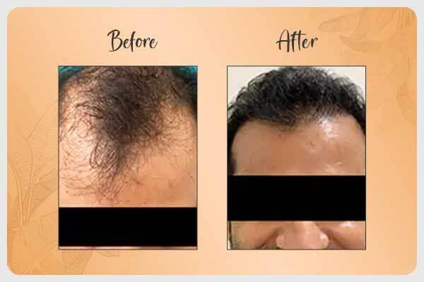 Before and After Hair Transplant 3