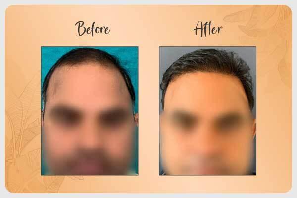 Before and After Hair Transplant 4