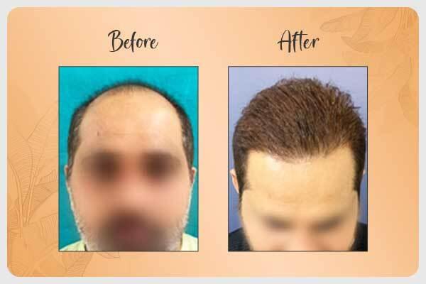 Before and After Hair Transplant 5