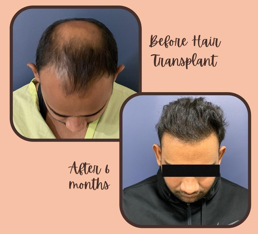 Why Opt Hair Transplant Treatment