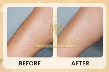 Laser hair removal before & after patient 2