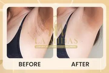Laser hair reduction before & after patient 3