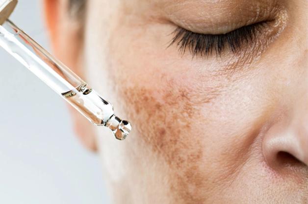 About Melasma Treatment