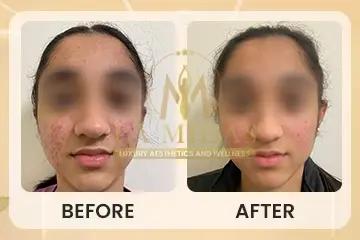 Before After Acne