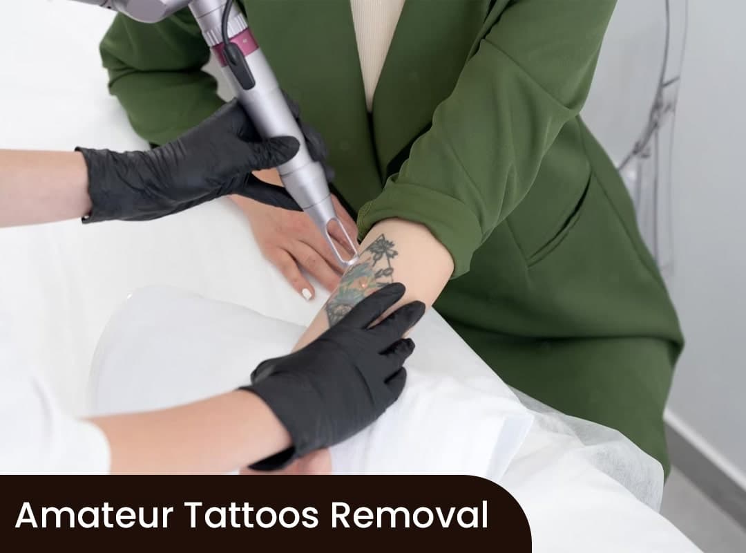 Amateur Tattoos Removal