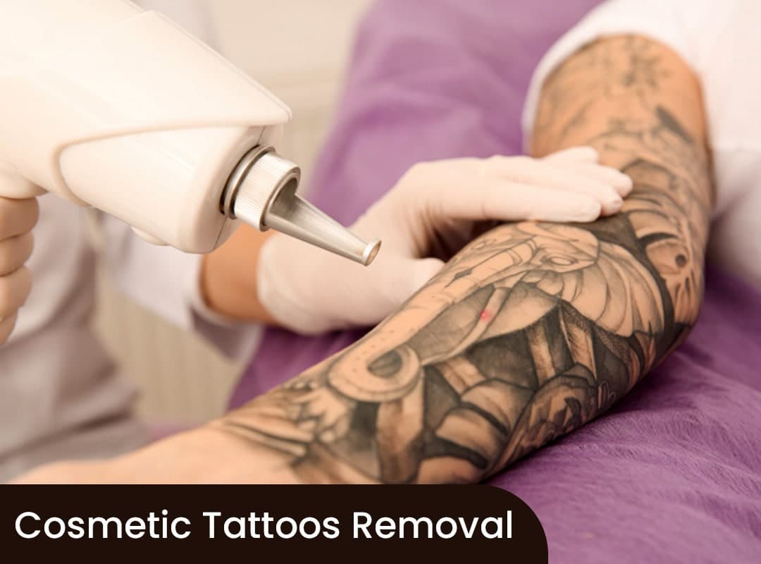 Cosmetic Tattoos Removal