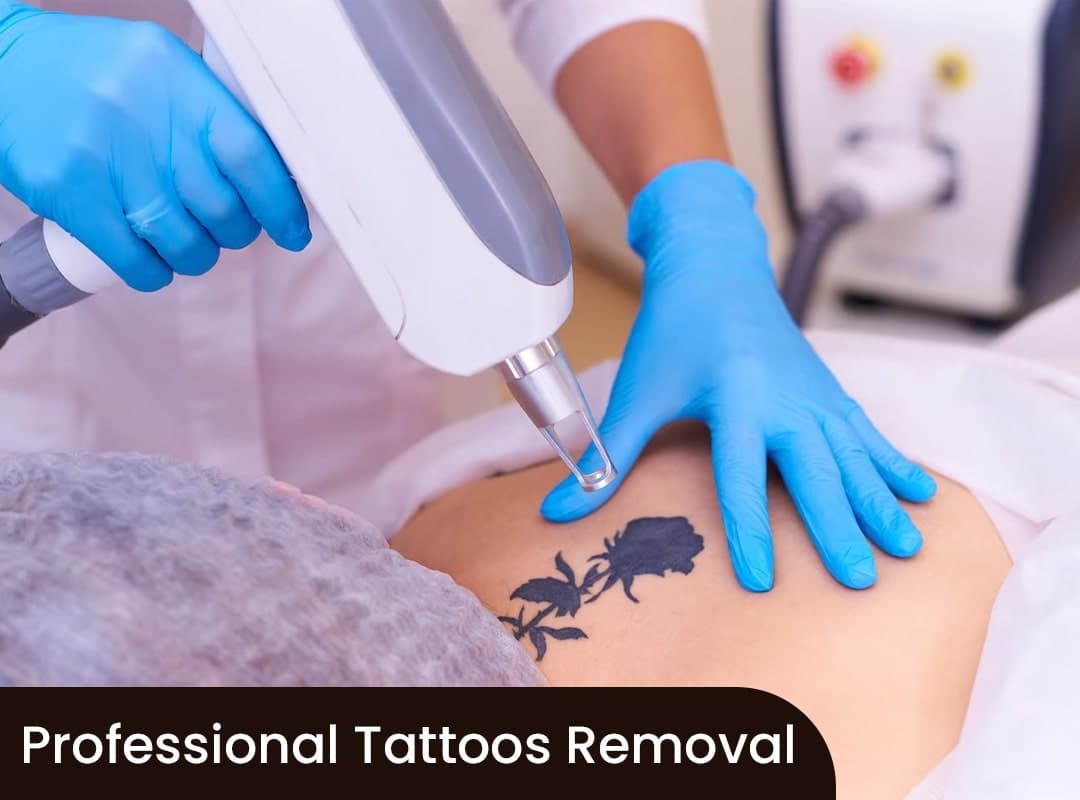 Professional Tattoos Removal