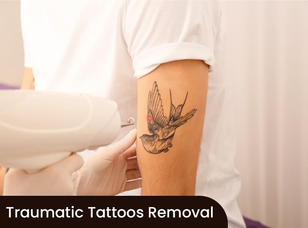 Traumatic Tattoos Removal