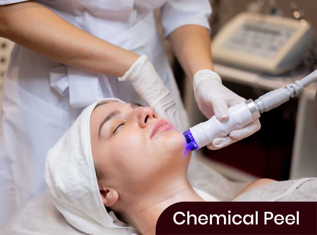 Chemical Peel