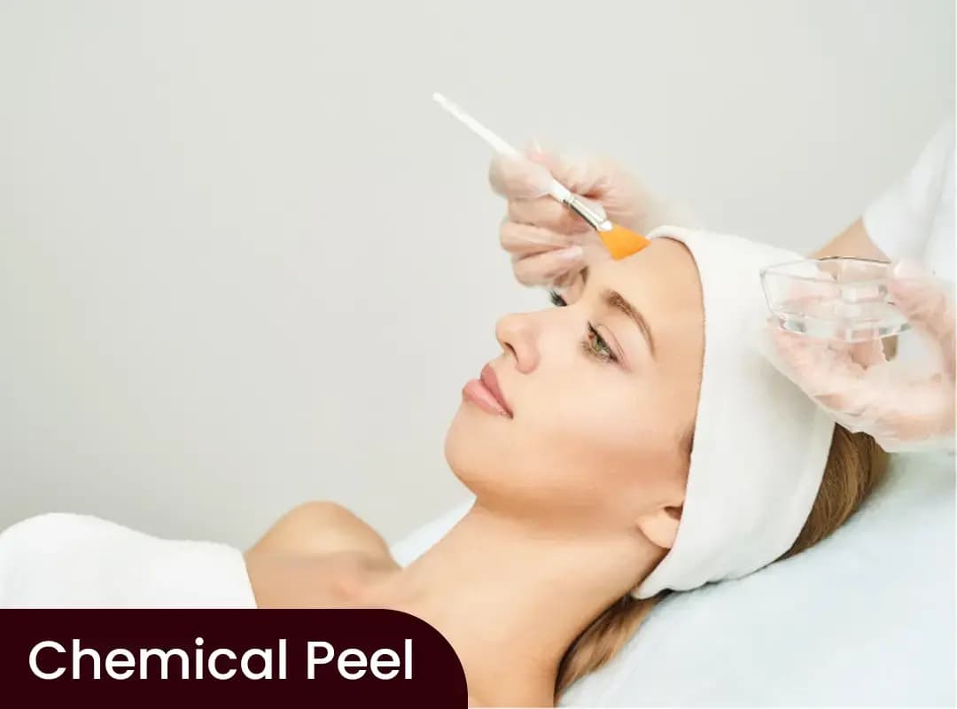 Chemical Peel