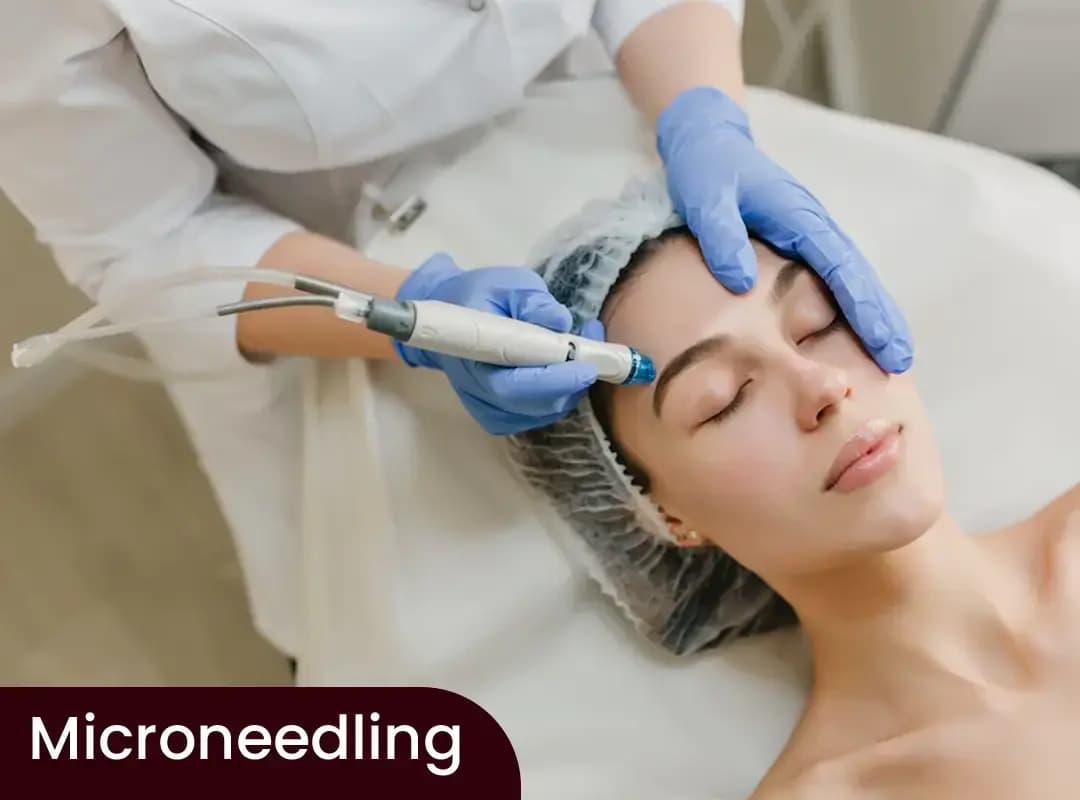 Microneedling