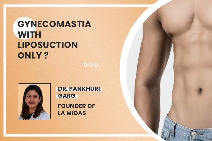 Gynecomastia With Liposuction Only?