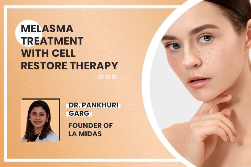 Melasma Treatment With Cell Restore Therapy