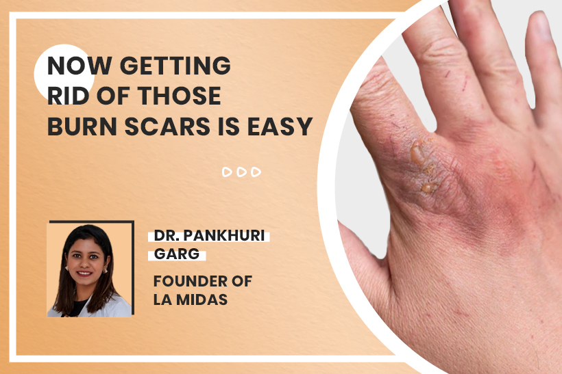 Now Getting Rid Of Those Burn Scars Is Easy